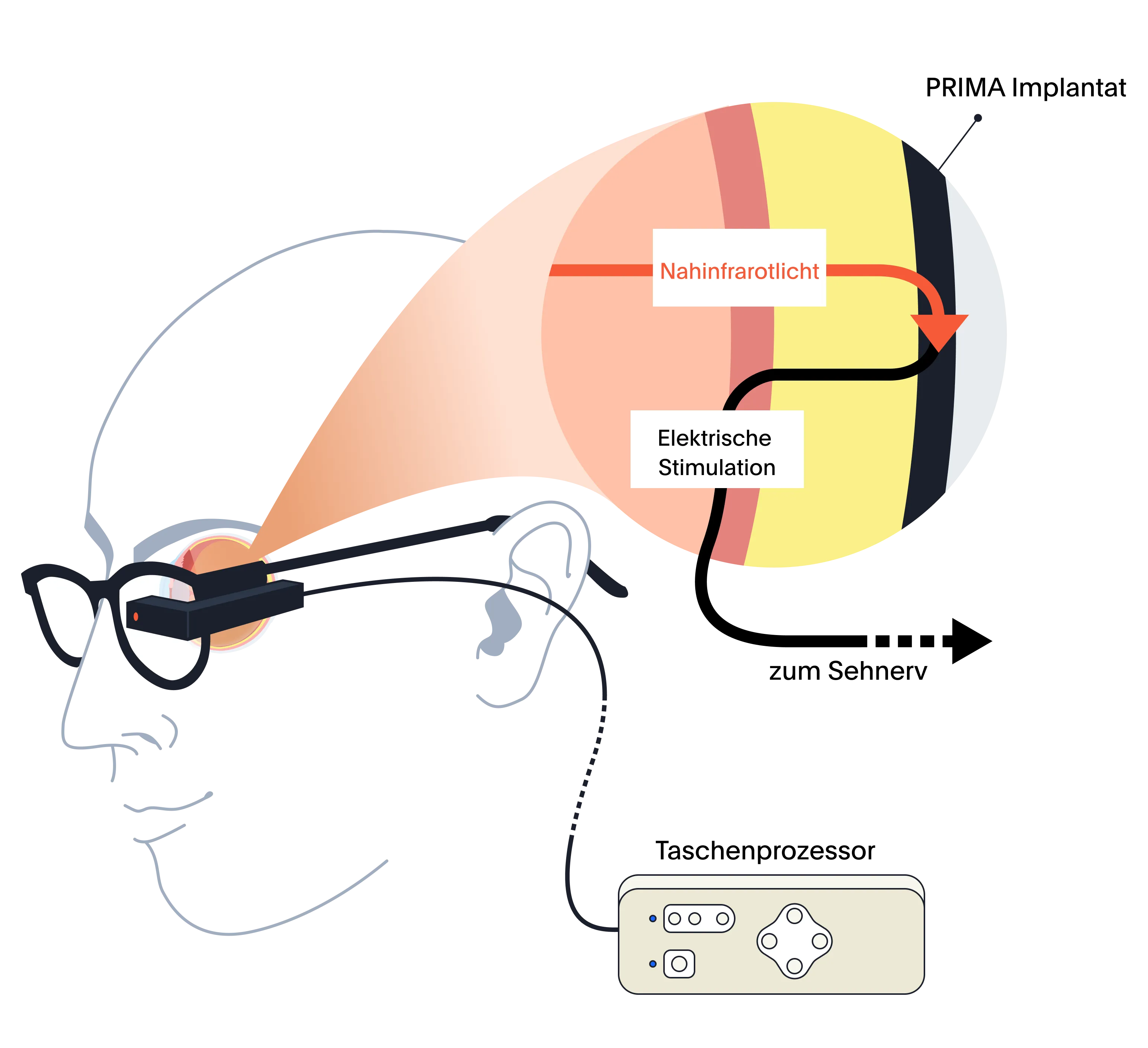 Der Wirkmechanismus von PRIMA: Die PRIMA-Brille ist mit dem Taschenprozessor verbunden und wird wie eine Brille getragen. Eine Detailansicht der Netzhaut zeigt, wie das PRIMA-Implantat die Funktion der Photorezeptorschicht ersetzt.