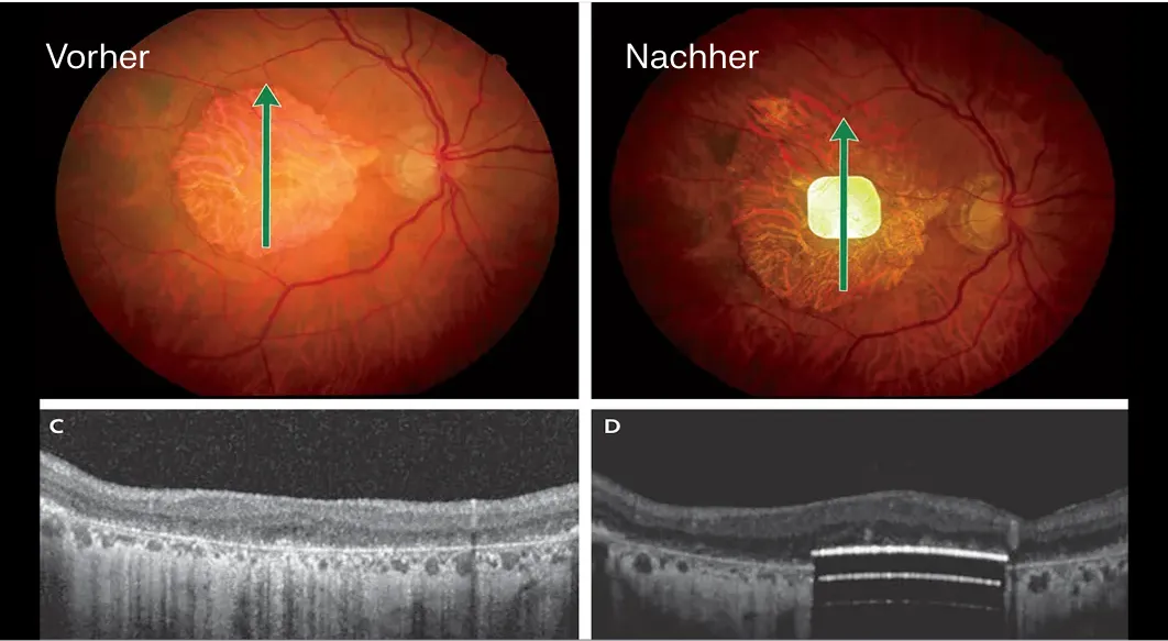 Fundus- und optische Kohärenztomografie (OCT)-Aufnahmen eines PRIMA-Patienten vor und nach der Implantation, die zeigen, wie das Implantat in der Mitte des Skotoms liegt